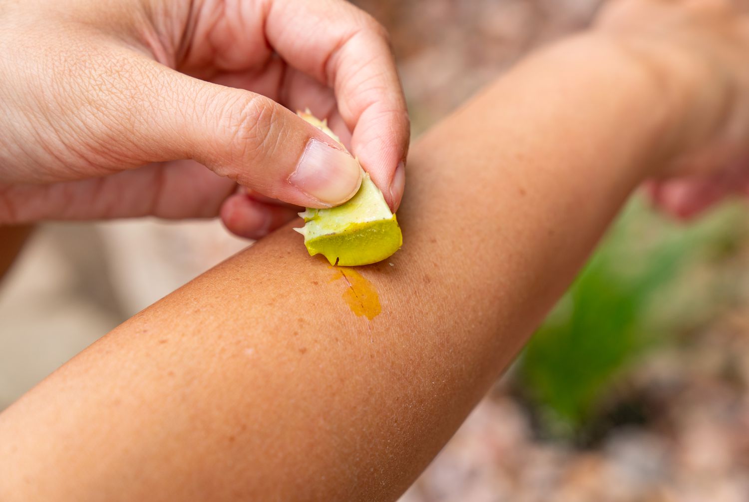 Aloe-vera-Schnitt mit freigelegtem Gel auf der Armverletzung